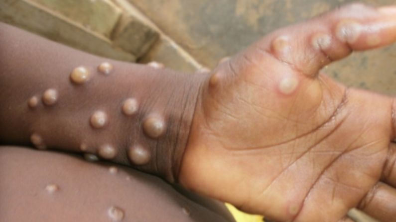 Monkeypox in US: कोरोना के बीच नई आफत! अमेरिका के टेक्सास में मिला